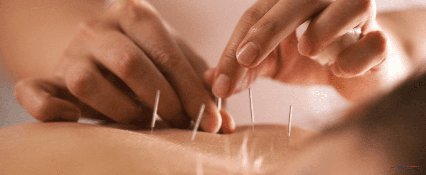 ACG-The doctor sticks needles into the girl`s body on the acupuncture