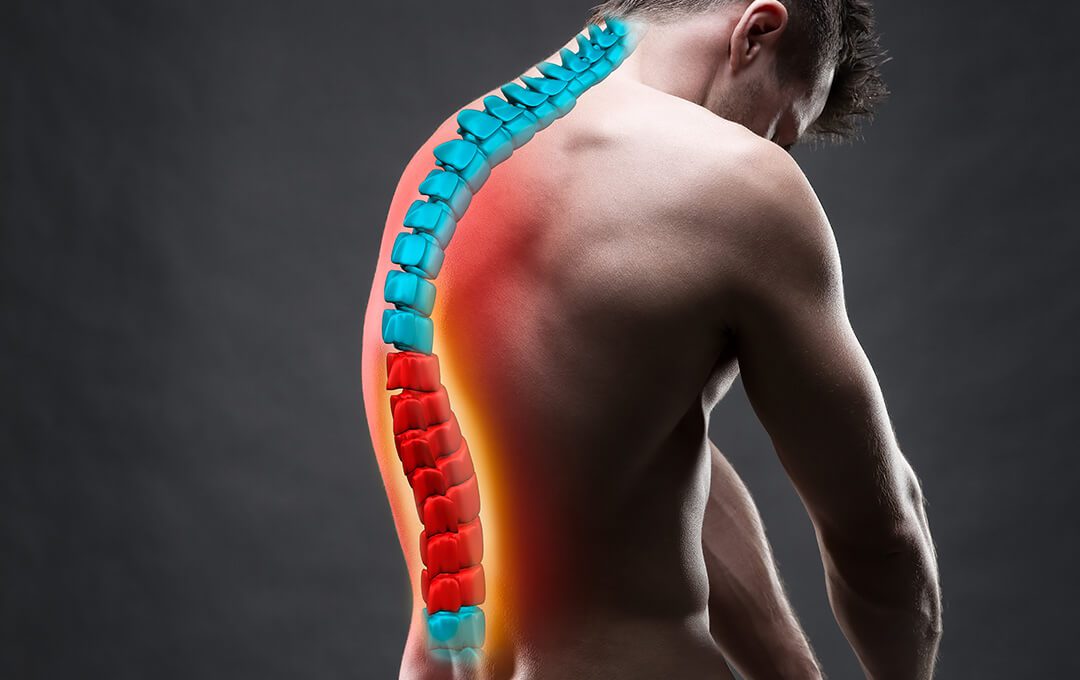 ACG Chiropractic Treatment for Herniation